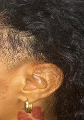 hair transplant photos