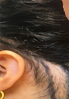 hair transplant photos