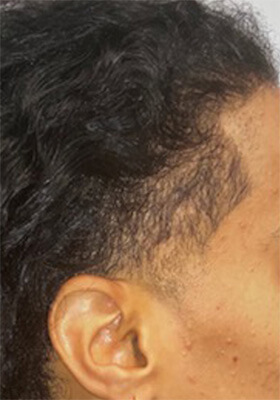 hair transplant photos