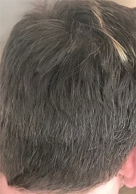 hair transplant photos