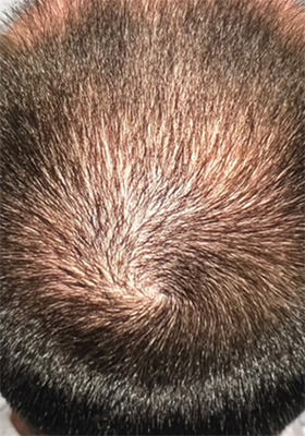 hair transplant photos