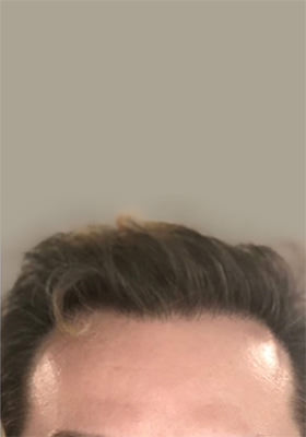 hair transplant photos