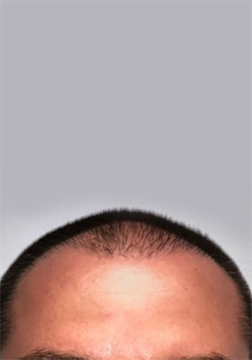 hair transplant before after Photos