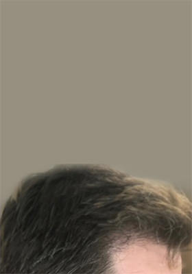 hair transplant before after Photos
