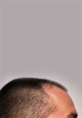 hair transplant before after Photos