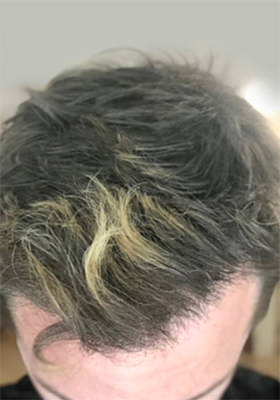 hair transplant before after Photos