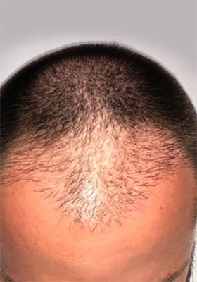 hair transplant photos