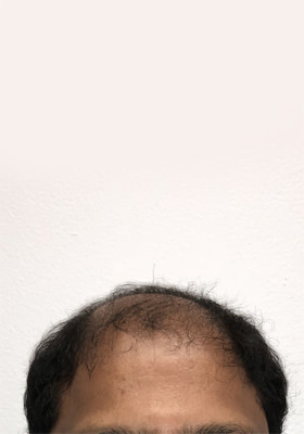 hair transplant photos