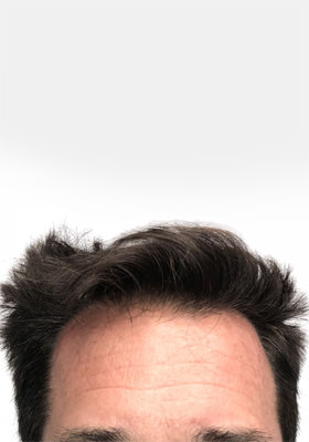 hair transplant photos