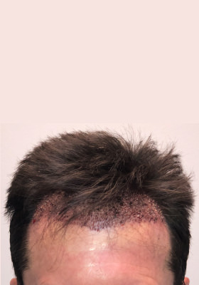 hair transplant photos