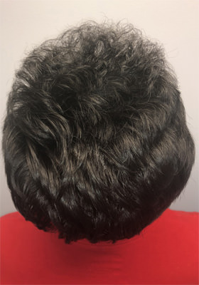 hair transplant photos