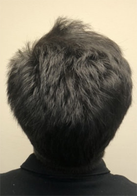 hair transplant photos