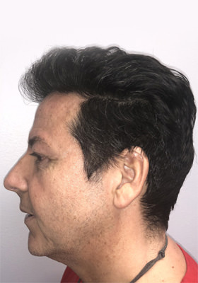 hair transplant photos