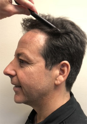 hair transplant photos