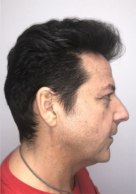 hair transplant before after Photos