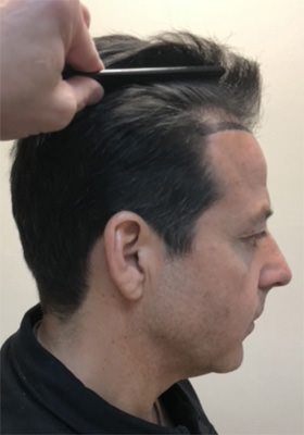 hair transplant photos