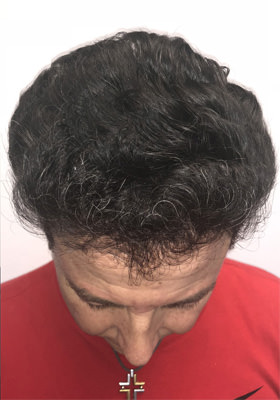 hair transplant photos