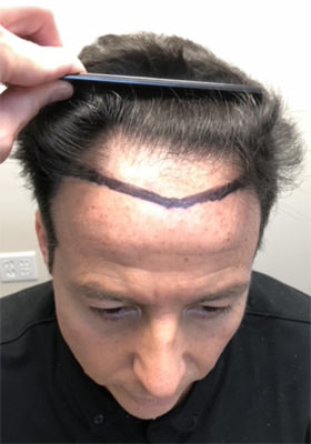 hair transplant before after Photos