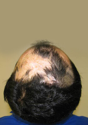 hair transplant before after Photos