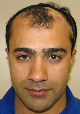 Dr Brett Bolton Patient Photos  - Rahim - Hair Transplant Updates