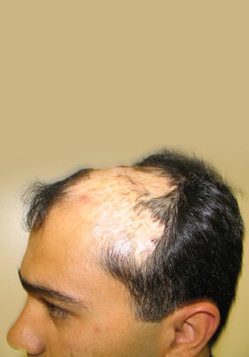 hair transplant photos