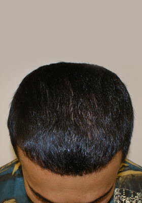 hair transplant photos