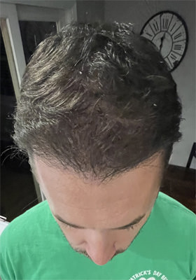 hair transplant before after Photos