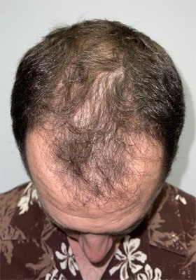 hair transplant before after Photos