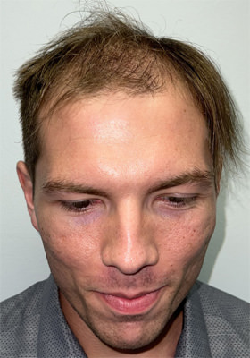 hair transplant photos