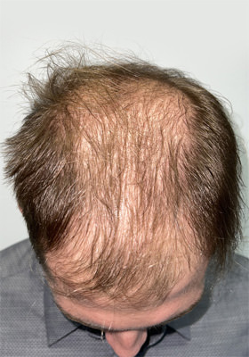 hair transplant photos