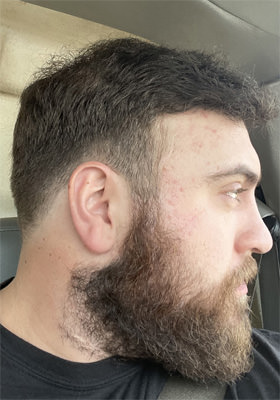 hair transplant before after Photos