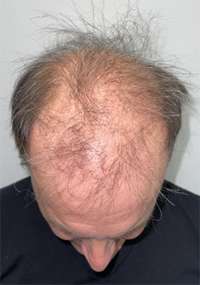 hair transplant before after Photos