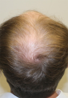 hair transplant photos