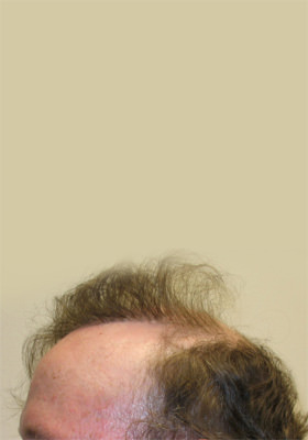 hair transplant before after Photos