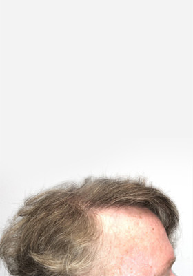 hair transplant photos