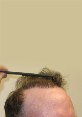hair transplant before after Photos