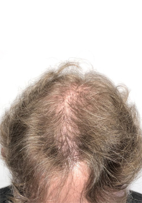 hair transplant photos