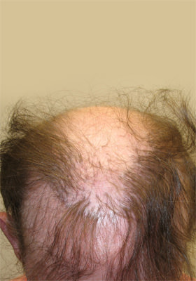 hair transplant before after Photos