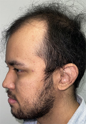 hair transplant before after Photos