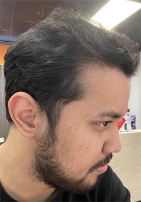 hair transplant before after Photos