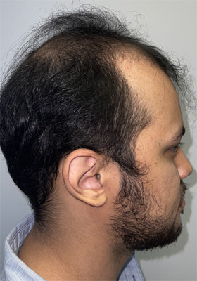 hair transplant photos