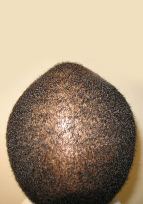 hair transplant photos