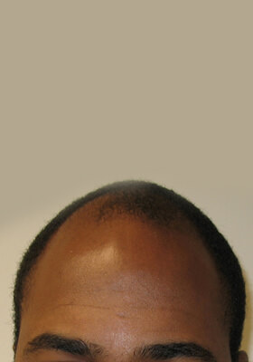 hair transplant photos