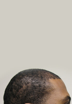 hair transplant photos