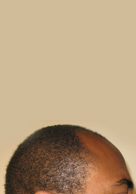 hair transplant before after Photos