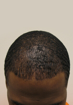 hair transplant photos