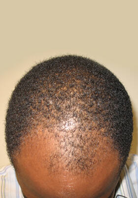 hair transplant photos