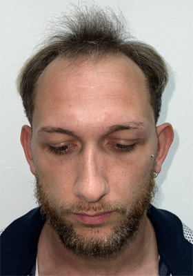 hair transplant photos