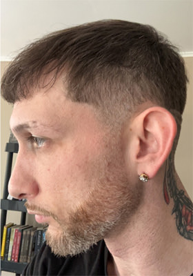 hair transplant before after Photos