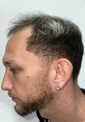 hair transplant before after Photos